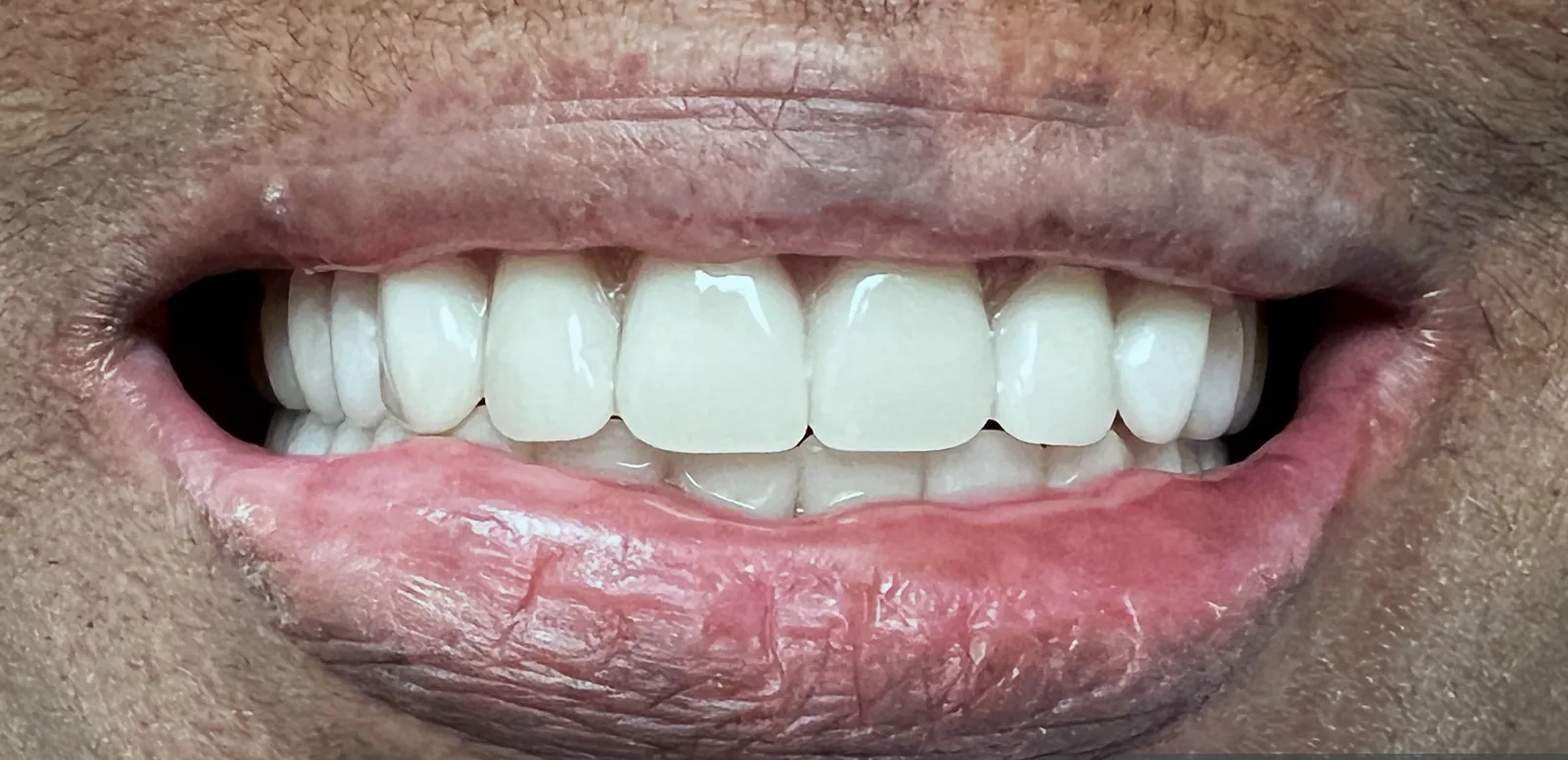 Case 02, after