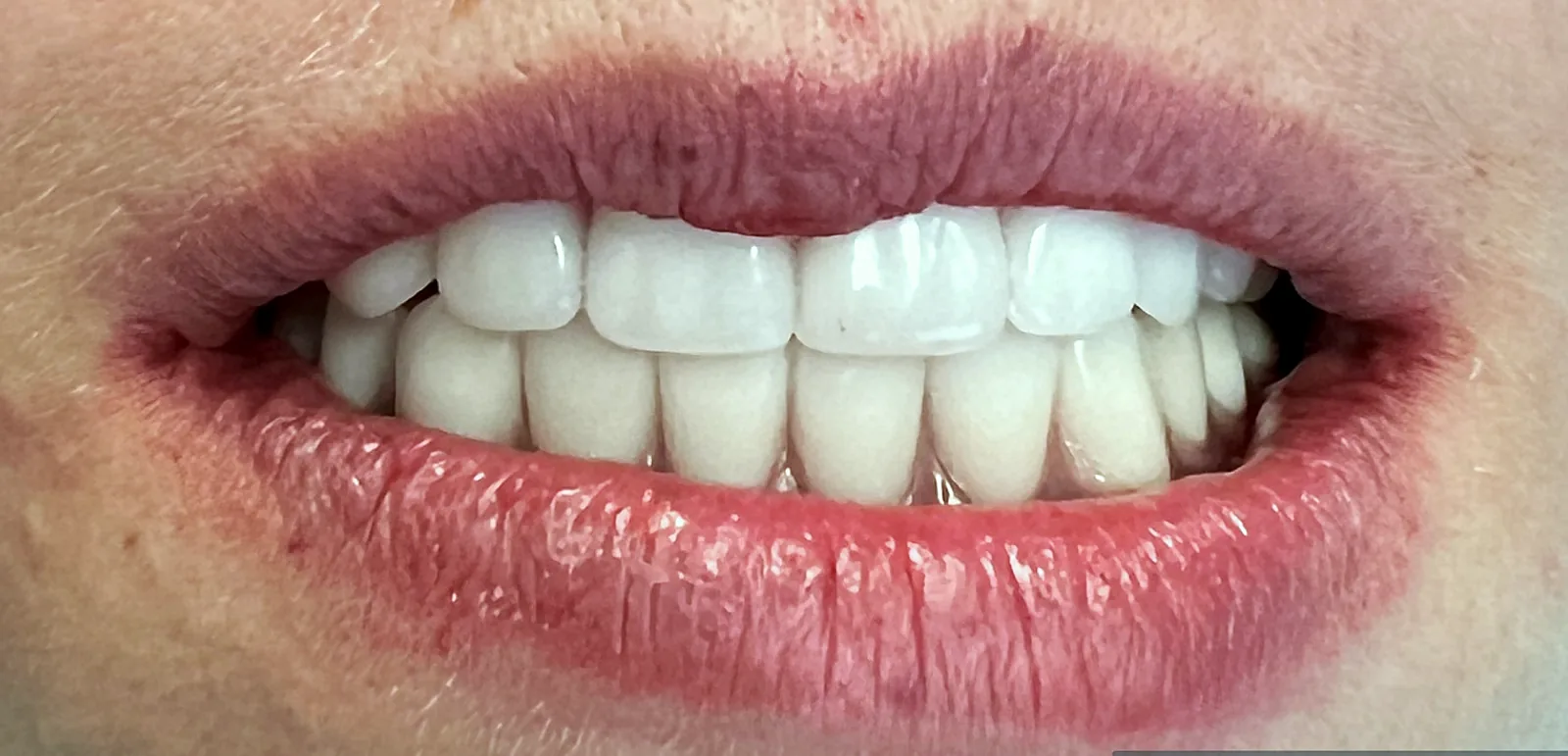 Case 04, after